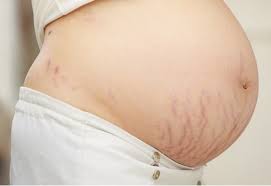 Garis hitam di perut tapi tidak hamil. 10 Cara Menghilangkan Stretch Mark Saat Hamil Secara Alami Hamil Co Id