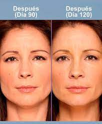 El bótox es una toxina que produce botulismo, una intoxicación que ocasiona parálisis muscular. Botox Controla El Envejecimiento Y Las Arrugas Cirugia Estetica Madrid Clinica Femm