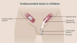 Undescended testicles in children - Guys and St Thomas Specialist Care