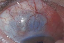 Image result for lesion sclera