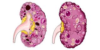 Itulah mengapa bruntusan kerap dialami bayi. Cyst Dalam Buah Pinggang Vitamin Cerdik By Coach Anah Ahmad