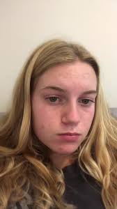 After 8 months of accutane I'm definitely happier and 100% more confid...