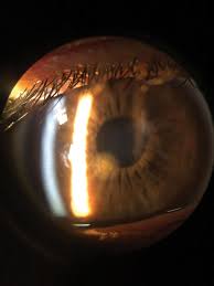 Image result for Eye Foreign Body