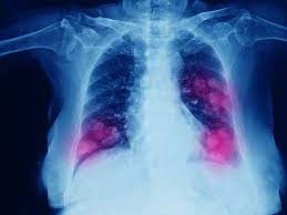 Early symptoms of mesothelioma are more often caused by other things, so at first people may ignore them or mistake them for common, minor ailments. The Horrible Truth About Being Diagnosed With Mesothelioma