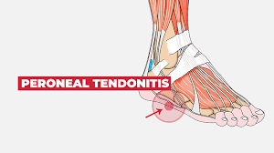 Running, as well as other activity, makes the pain worse. 29 Quick Solutions That Every Runner With Foot Pain Need To Know