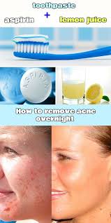 How To Remove Acne Overnight Acne Overnight Acne Cure Home Remedies For Acne