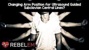 The analysis is based on the classification of expenses as variable (expenses that vary in direct proportion to sales volume) or fixed (expenses that remain unchanged over the long term, irrespective of the sales volume). Changing Arm Position For Ultrasound Guided Subclavian Central Lines Rebel Em Emergency Medicine Blog