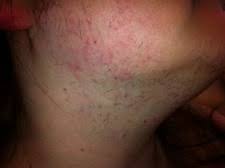 Women typically report irregular, infrequent periods. Pco Syndrom Facharzt Spezialist Bochum Ruhrgebiet Nrw