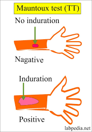 Tb may cause an inactive (latent) infection or an active, progressive disease. Mycobacterium Tuberculosis Part 2 Mantoux Test Tt Tuberculin Skin Test Labpedia Net