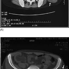 Gharbi classification of hydatid cyst. The Gharbi Classification For Hydatid Cysts Download Table