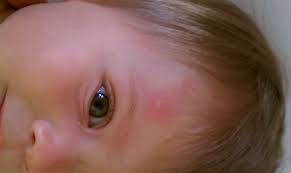 Allergic To Dog Saliva Fussy Buns