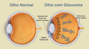 Ilustração do olho e do nervo óptico sob pressão.