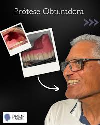 Entregue e aprovada! ✓ Prótese Obturadora. Você sabe o que é e para que  serve? Esta prótese é fundamental para pacientes que passaram por cirurgias  na região do palato (céu da boca).