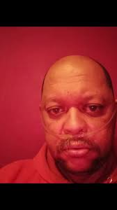 David Vetter Cause of Death