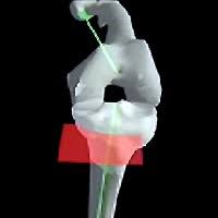 Knee Navigation Systems (KneeNav TKR/ACL)