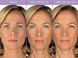 We did not find results for: How Much Do Botox Injections Cost In The Pasadena Area Facial Plastic Reconstructive Surgery Pasadena Glendale Ca