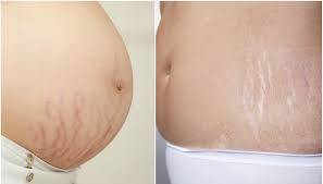 Cel mai adesea, inflamația și creșterea hemoroizilor apar sub influența mai multor factori nefavorabili. Diferenta Dintre Vergeturile Rosii Si Cele Albe Revista Baby Pentru PÄrinti Èi Copii