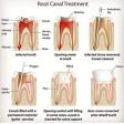 Root Canal Treatment ( RCT ) by Best Dentist in Dwarka product image