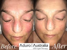 Red light is usually followed by, or combined with, yellow or amber light. Red Led Light Therapy For Rosacea Does It Work