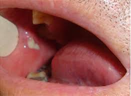 Image result for Sialoadenitis