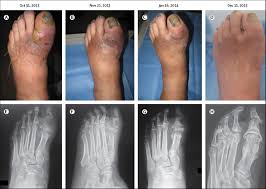 Image result for Osteomyelitis