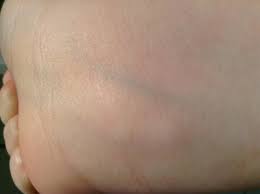 3 Knubbel Im Handrucken Der Rechten Hand In Der Vene Was Ist Das Venen Ader