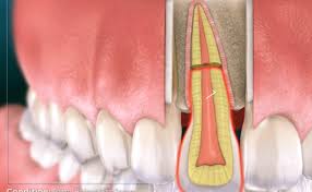 Image result for Tooth Fracture