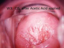 Image result for Colposcopy Findings