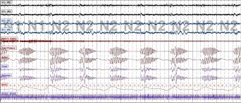 Image result for Cheyne-Stokes Respiration