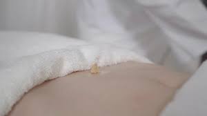 Gynecologists are not only experts in gynecology abroad. Doctor Lighting Up Moxa On Female Belly Professional Caucasian Acupuncturist Healing Stomachache Or Gynecological Problems Of Unrecognizable Young Woman Direct Moxibustion Acupuncture Stock Video Footage Storyblocks