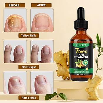 Tratamiento de hongos en las uñas, sérum de jengibre para uñas de pies y manos - Sérum reparador para uñas descoloridas, engrosadas y dañadas, aceite hidratante para cutículas, 60 ml : Amazon.es: Belleza