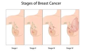 Breast cancer is the most common cancer in women. 5 Stages Of Breast Cancer And Its Treatment Medanta