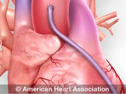 Heart Procedures And Surgeries American Heart Association