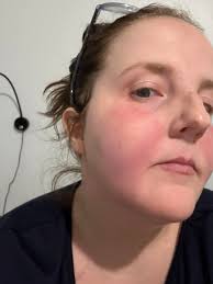 Help please. The internet has brought me down many paths but POTS blood  pooling came up the most similar images. I'm trying to get some real ideas  of what's going