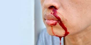 Nasal vestibulitis is medical terminology for a pimple inside the nose. Nasal Scraping Self Harm Trend New Trend Among Singapore Youths Theasianparent