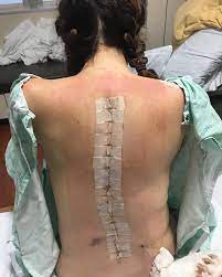 Holly's Scoliosis Journey... - Holly's Scoliosis Journey
