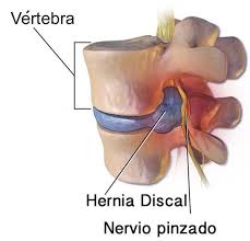 Hernia Cervical Tratamiento Quiropractico Gracia Quiropractica