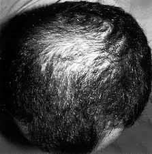 The exact way that this medicine works is not known. How Eucapil Works Eucapil Shop Deutschland Hair Care Agent For Topical Use In Androgenetic Alopecia Hair Loss