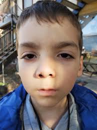 Child comes home with black eye
