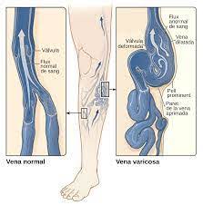 Best Compression Socks For Varicose Veins