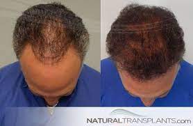 Hair Growth Friday Amazing Hair Growth Results After Natural Transplants Hair Transplant Procedure Call Us Hair Restoration Cool Hairstyles Hair Transplant