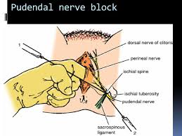 Image result for Pudendal Block