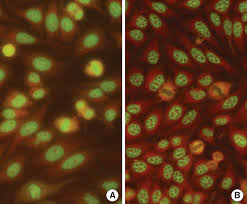 Image result for ANA Staining Pattern