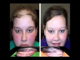 With the help of lllt, laser caps have shaped the hair growth industry. Laser Hair Therapy Lllt Low Level Laser Therapy Youtube
