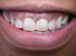 Srishti bhatia, associate director of. White Fillings Bonding Dr Mark Venincasa Dds General Cosmetic Dentistry In Dallas