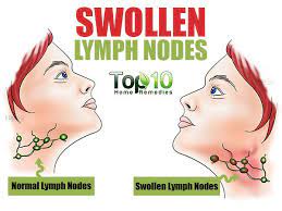 Home Remedies For Swollen Lymph Nodes Top 10 Home Remedies Swollen Lymph Nodes Remedies For Swollen Tonsils Lymph Nodes