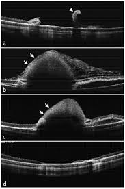 Their causes, symptoms, and treatment options. Optical Coherence Tomography Oct Findings After Vitrectomy With Download Scientific Diagram