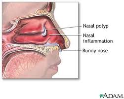 Read about the symptoms, causes, treatments and when to see a gp. Nasal Polyps Lima Memorial Health System