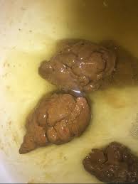Image result for blood in stool human poop
