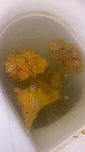 Image result for blood in stool human poop